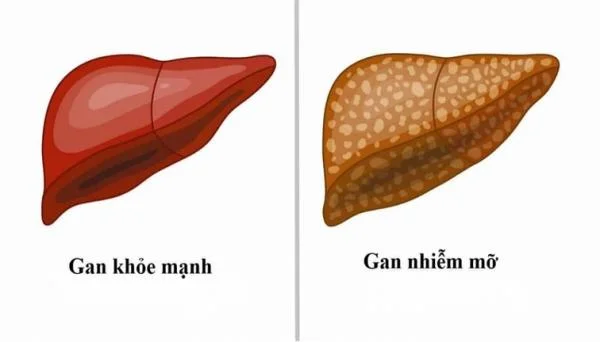 Tại sao gan nhiễm mỡ ? Thắc mắc của rất nhiều bệnh nhân