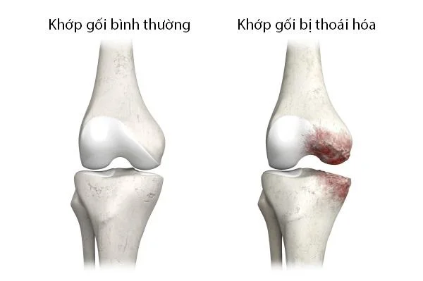 Thoái hoá khớp diễn ra như thế nào...?