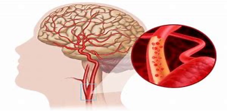 thiếu máu não ở người trẻ