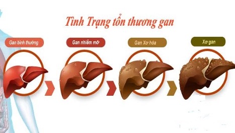 Những giải pháp giúp Gan phục hồi và khỏe mạnh