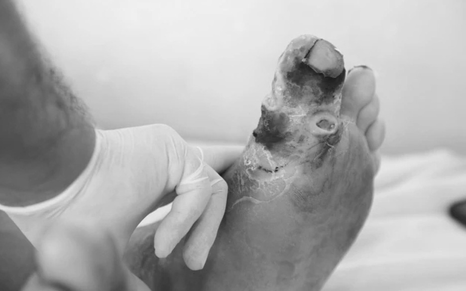 nhung-bien-chung-cua-benh-tieu-duong