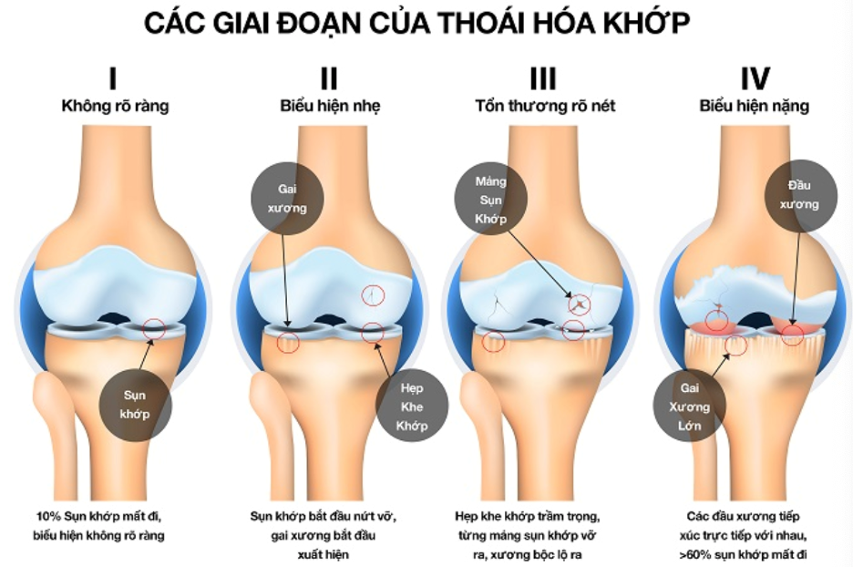 Các giai đoạn của quá trình thoái hoá khớp